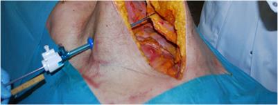 Minimally Invasive Tensiometry: A New Modality for Per-Operative Measurement of Medialization and Tension During Laparoscopic Hernia Surgery